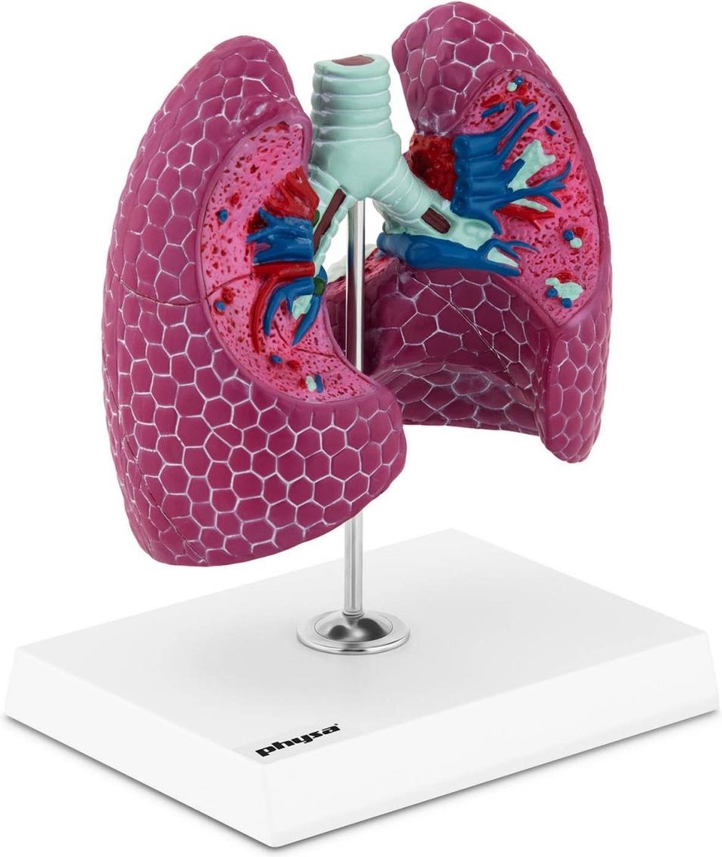 physa Longmodel - met pathologieën