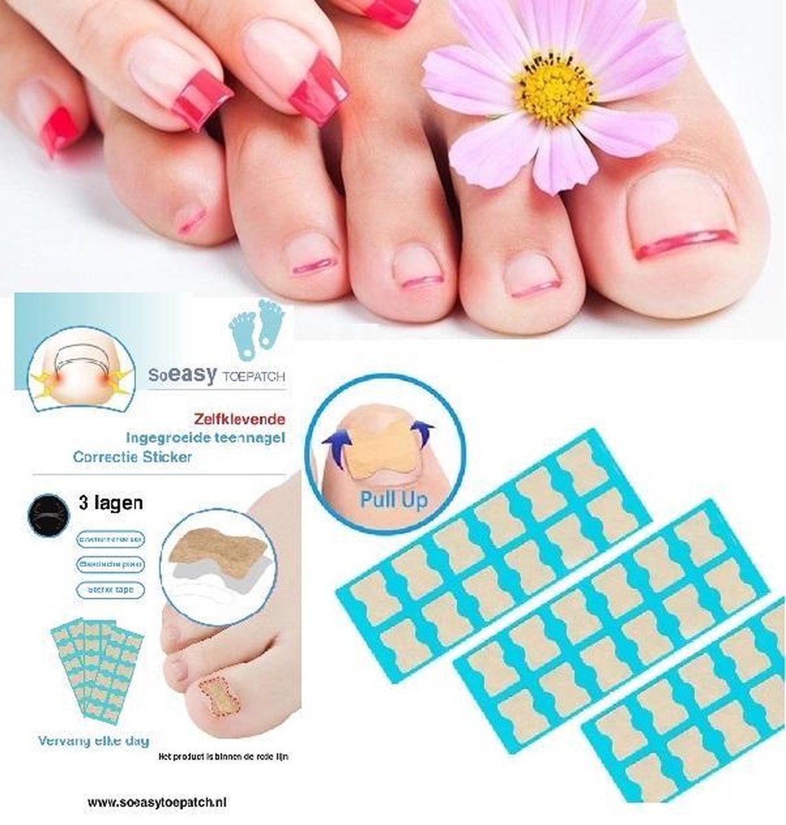 LaVidaLuxe® - De Originele SoEASY Toepatch® - voor 1 maand - Ingegroeide teennagel Corrector - Ingegroeide Teennagel - Teennagels - Ingegroeide Teennagel Lifter - Kalknagel product - Teen Pleister - teennagel pleister - pedicureset - schimmelnagel