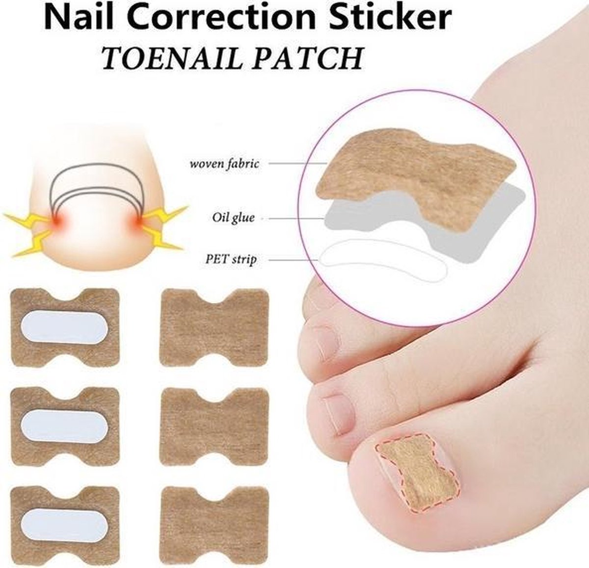 Ingegroeide teennagel Corrector
