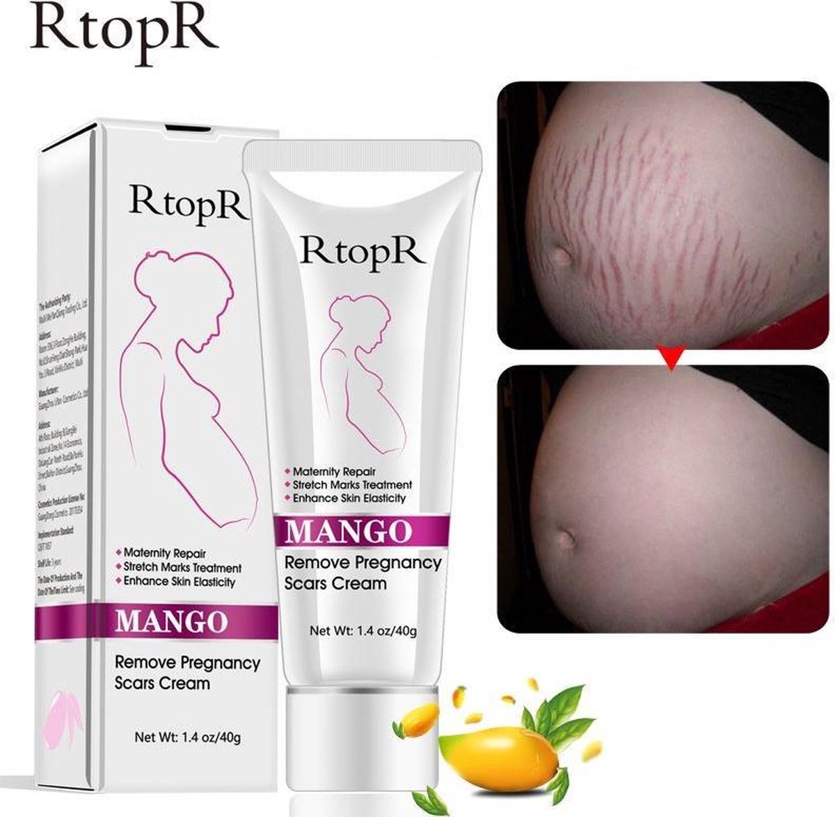 Zwangerschap litteken op buik Verwijderen - Striae verwijderen - Anti Rimpel - Huid Reparatie - Zwangerschap Littekens Behandeling - Lichaam Huidverzorging - litteken verwijderen- anti striae creme - Zwangerschap striemen - afvallen - snel afgevallen