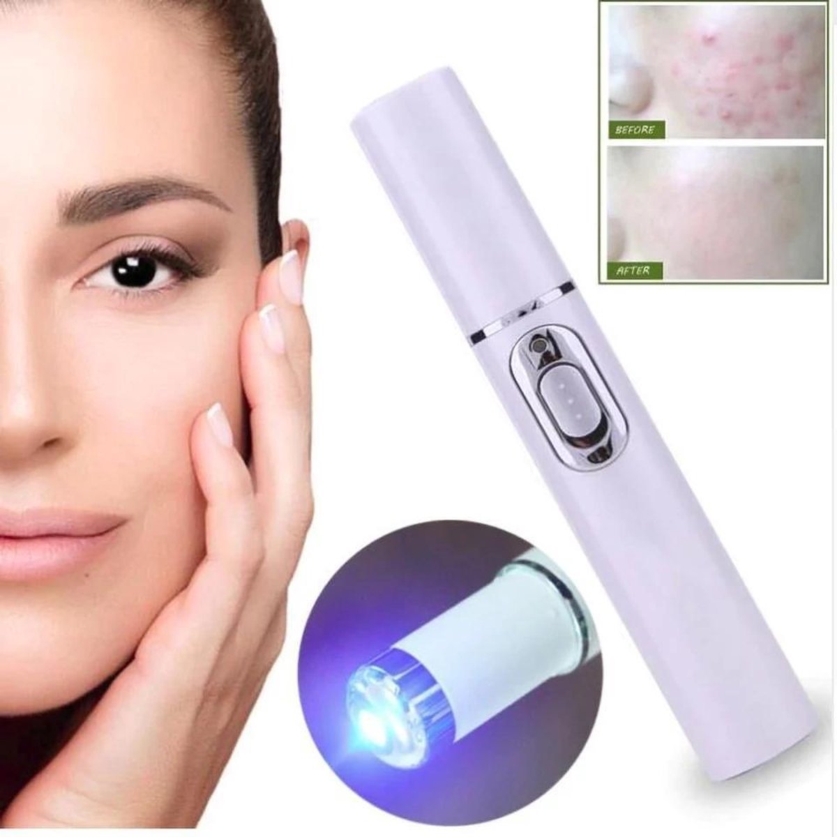 Acne laser pen -Bleu light therapy- litteken- rimpel- puisten Verwijderaar- wrinkle removal