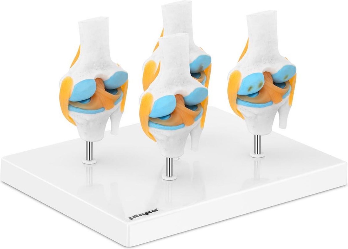 physa Knie - Kniemodel - 4 stadia Artritis - halve schaal