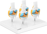 physa Knie - Kniemodel - 4 stadia Artritis - halve schaal