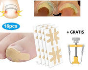 LaVidaLuxe® - De Originele SoEASY Toepatch® - 4x4 - Ingegroeide teennagel Pleisters - NU MET Teennagel Corrector - Teennagels - Ingegroeide Teennagel Lifter - kalknagelproduct - pedicure set