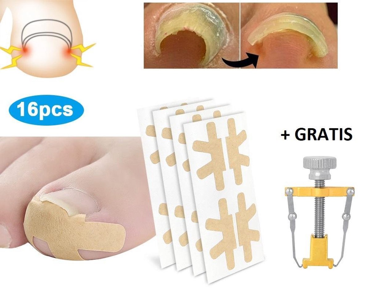 LaVidaLuxe® - De Originele SoEASY Toepatch® - 4x4 - Ingegroeide teennagel Pleisters - NU MET Teennagel Corrector - Teennagels - Ingegroeide Teennagel Lifter - kalknagelproduct - pedicure set