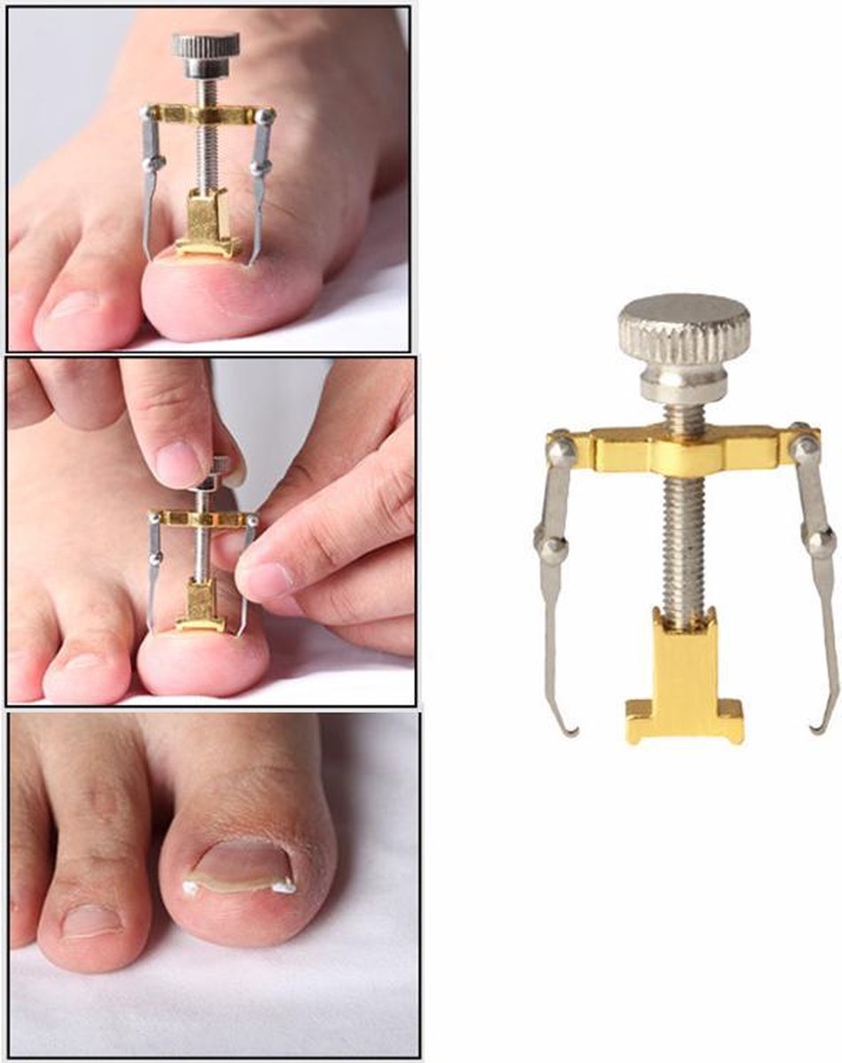 Ingegroeide teennagel | Nagelknipper | Teen nagel |Kalknagel | Pedicure | Manicure | Nagel Knipper | Nagel Schaar | Corrector | Nagelknipper | Nagelschaar