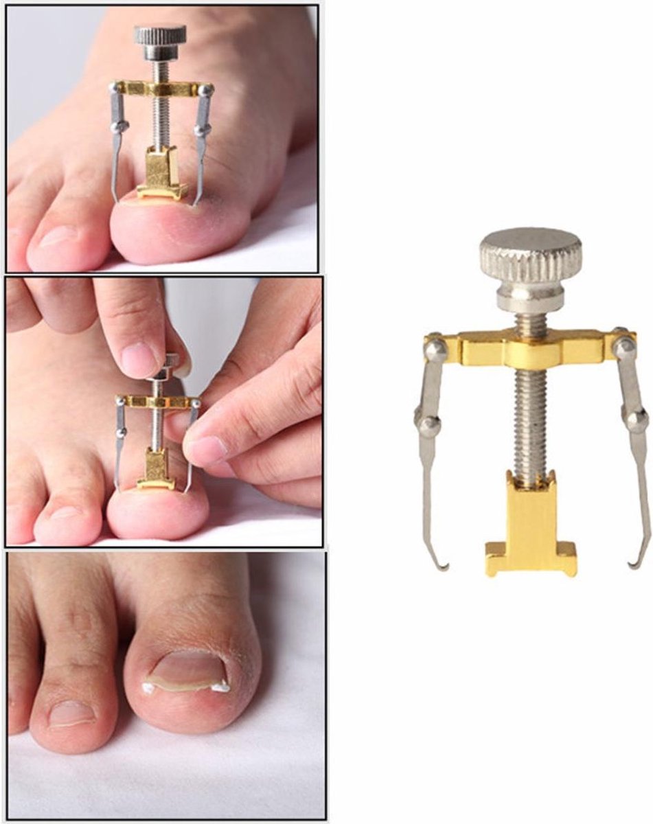 Ingegroeide teennagel Corrector| Nagelknipper voor teen nagel en kalknagel | Pedicure | Nagel Schaar & Knipper | Nagelschaar